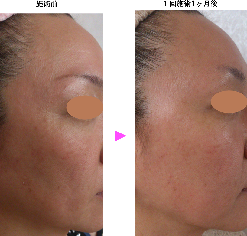 水光注射（ダーマシャインプロ）：施術メニュー：サ行｜銀座ケイスキン