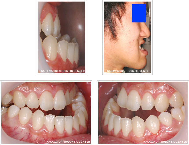 小児矯正における早期治療の意味 | は世界水準の治療を行います