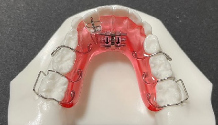 矯正装置紹介｜稲毛駅徒歩3分の矯正歯科｜つみき矯正歯科稲毛