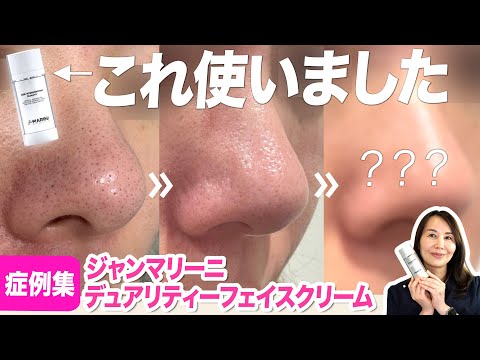 Medical Exclusive] For pores and acne! Three consecutive cases of