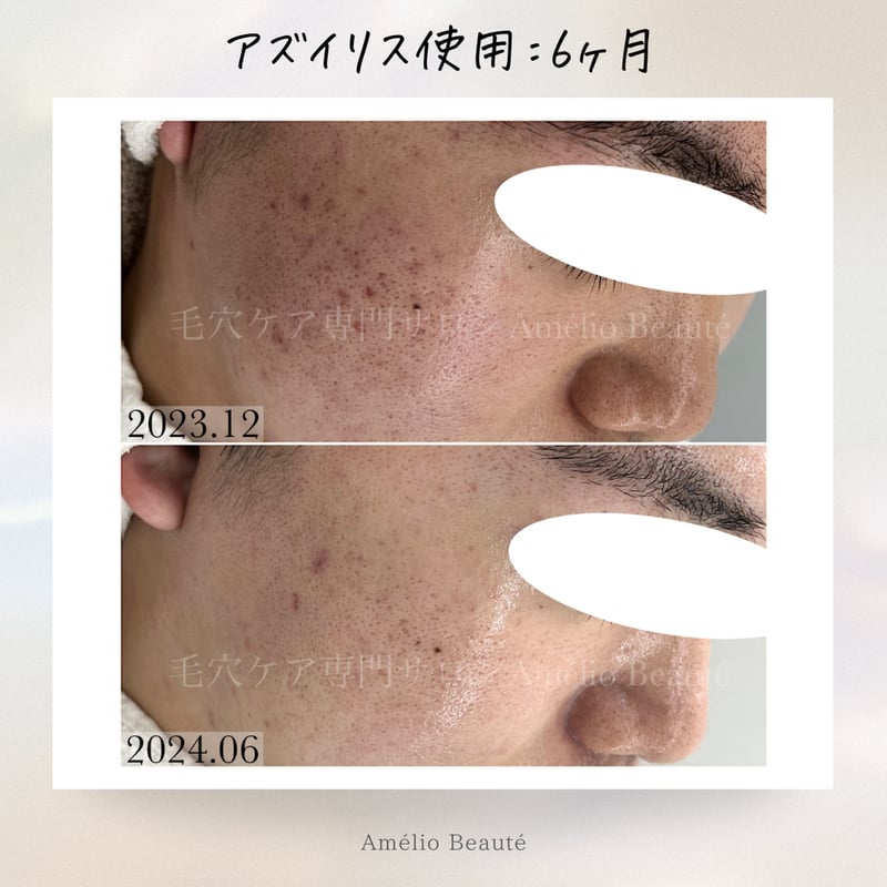 アズイリス 【As_iris】 炭酸ガスペーストパック 経皮吸収剤