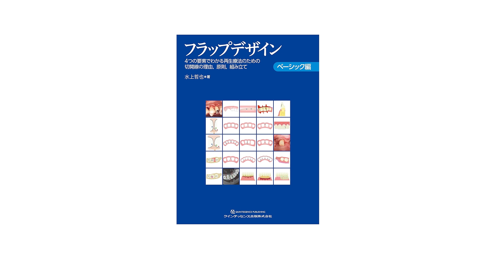 フラップデザイン ベーシック編: 4つの要素でわかる再生療法のための