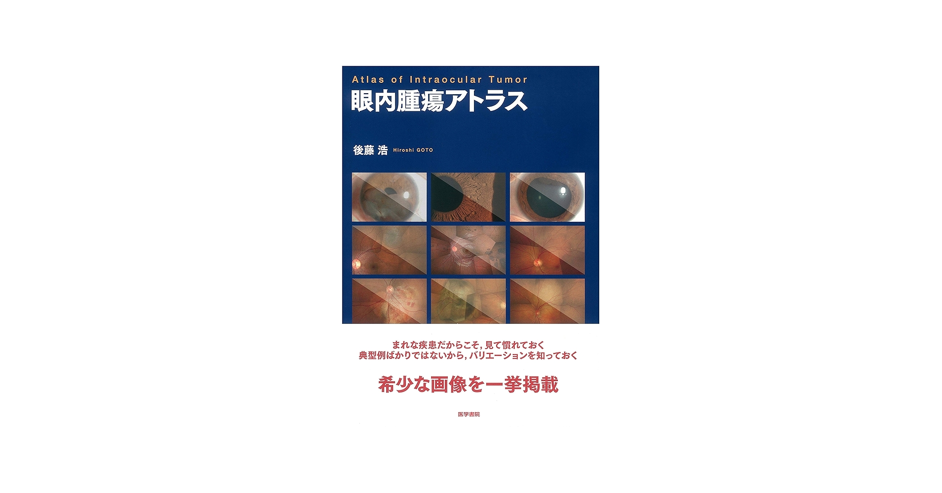 Amazon.co.jp: 眼内腫瘍アトラス : 後藤 浩: 本