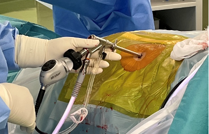 全内視鏡下脊椎手術 （いわゆるPED手術） | 診療科・部門 | 黒部市民