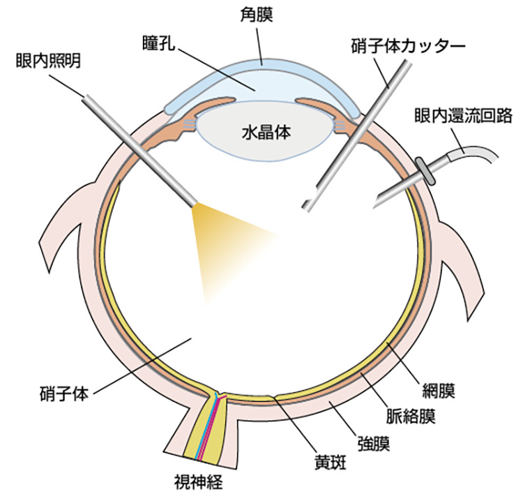硝子体手術による網膜疾患の治療 | 病気と治療の検索サイト