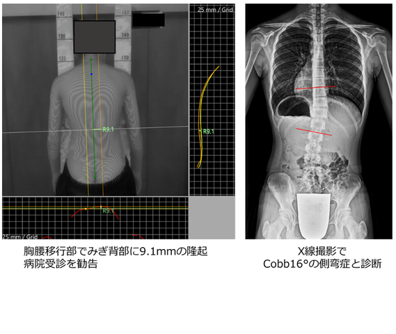新しい側弯症学校検診・進捗状況について - 新しい側弯症学校検診