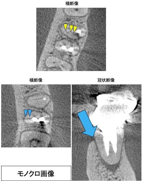 歯科用CT攻略マニュアル2023】見えなかったモノが視える！ 画像による