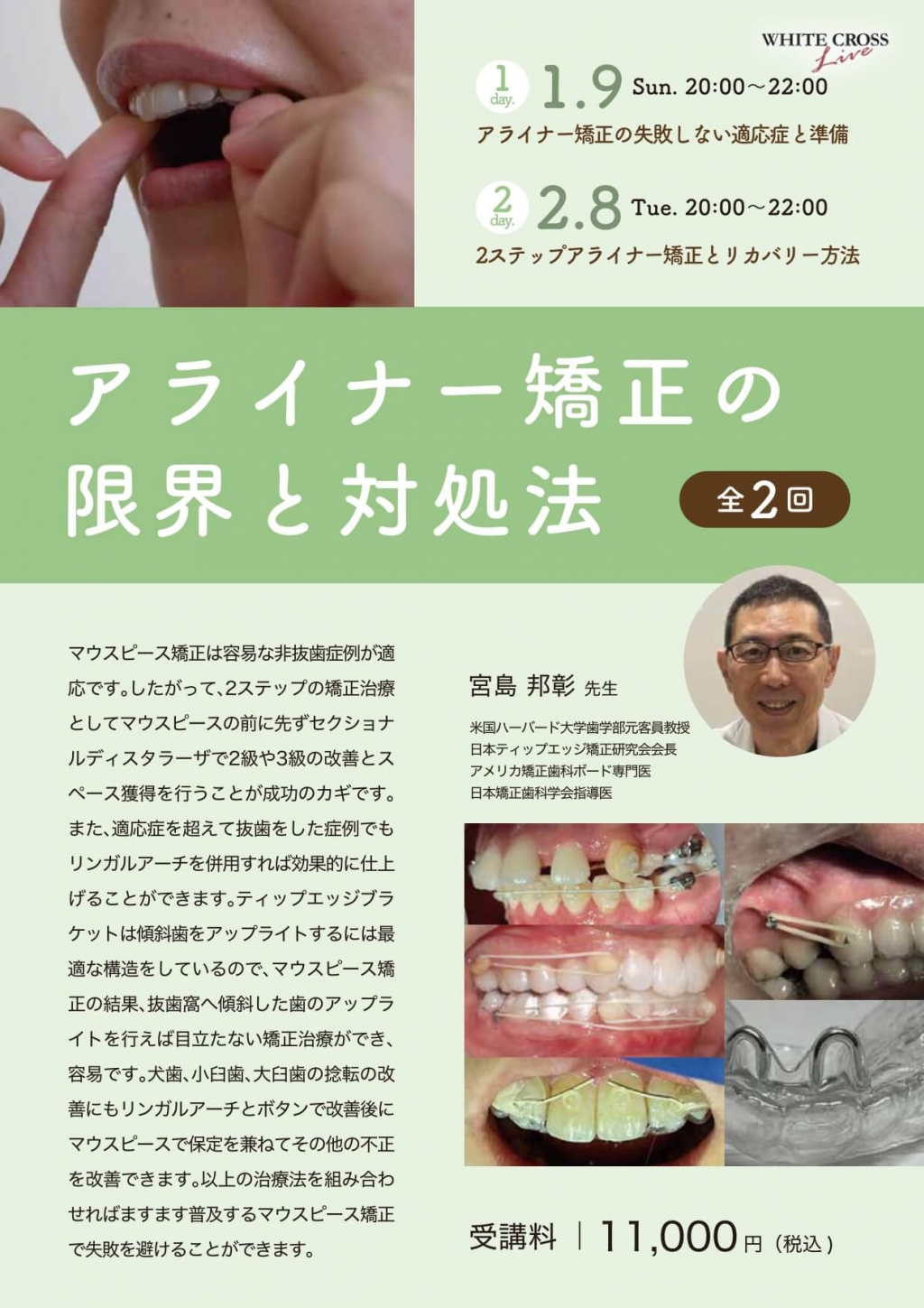 録画配信］アライナー矯正の限界と対処法 | WHITE CROSS