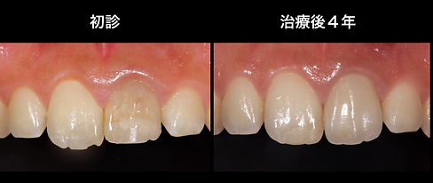 審美修復 審美補綴（前歯を綺麗にする） | つかだ歯科医院【公式】船橋