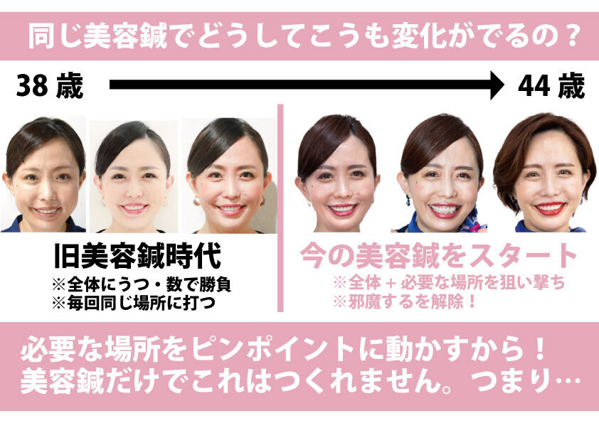 美容鍼についての説明