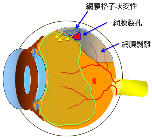 網膜の外科的治療（手術）について | 【高松e眼科】Day Surgery 高松の